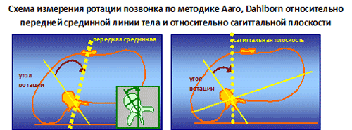 ротация позвонка