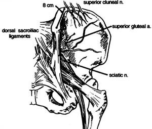 Эностоз крыла подвздошной кости справа