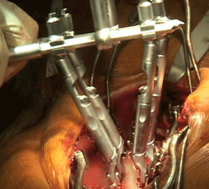 Vertebral Column Manipulation (VCM) 